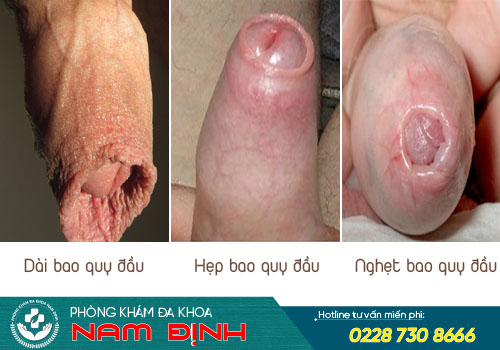 khám bao quy đầu