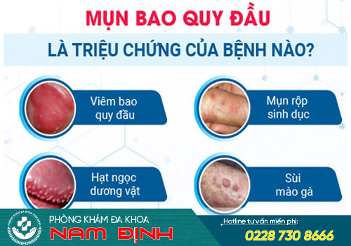 mụn bao quy đầu