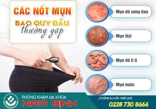 mụn bao quy đầu