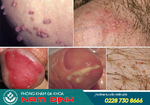 ngứa dương vật