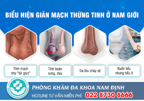 Giãn tĩnh mạch thừng tinh hoàn là gì?